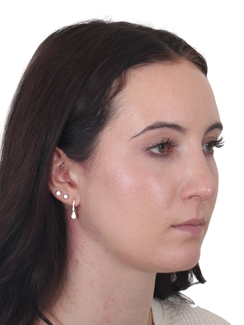 Rhinoplasty Before & After Gallery - Patient 260600 - Image 4