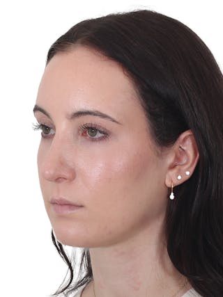 Rhinoplasty Before & After Gallery - Patient 260600 - Image 8