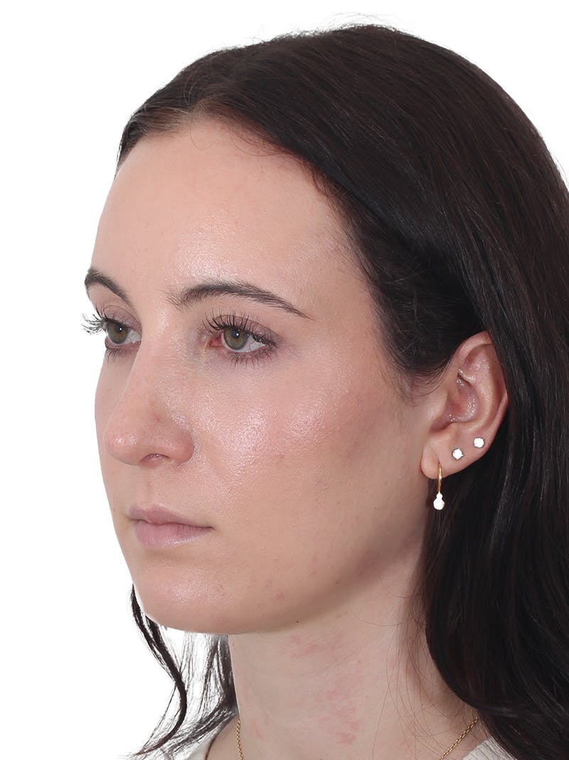 Rhinoplasty Before & After Gallery - Patient 260600 - Image 8