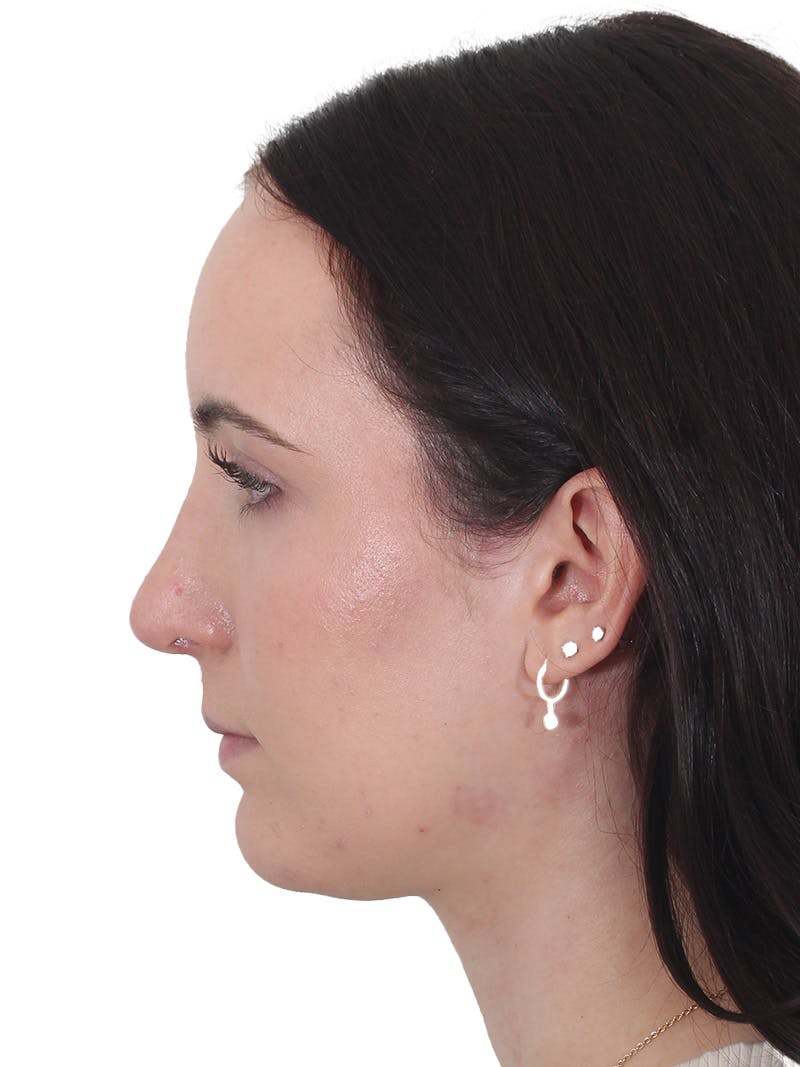 Rhinoplasty Before & After Gallery - Patient 260600 - Image 10