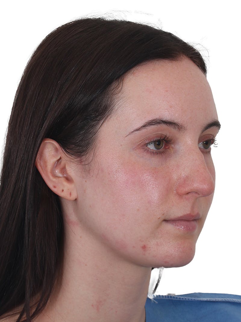 Rhinoplasty Before & After Gallery - Patient 260600 - Image 3
