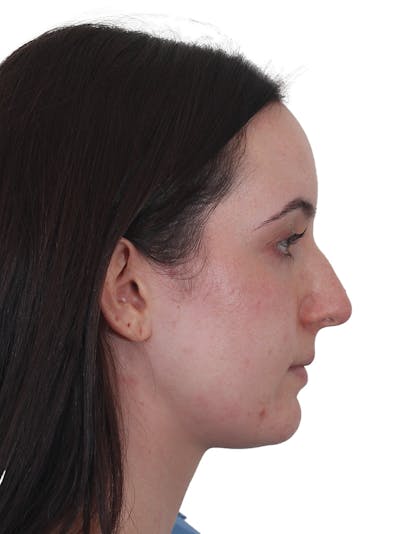 Rhinoplasty Before & After Gallery - Patient 260600 - Image 1