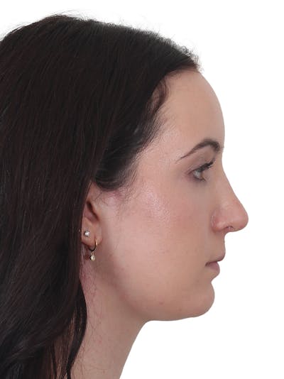 Rhinoplasty Before & After Gallery - Patient 260600 - Image 2