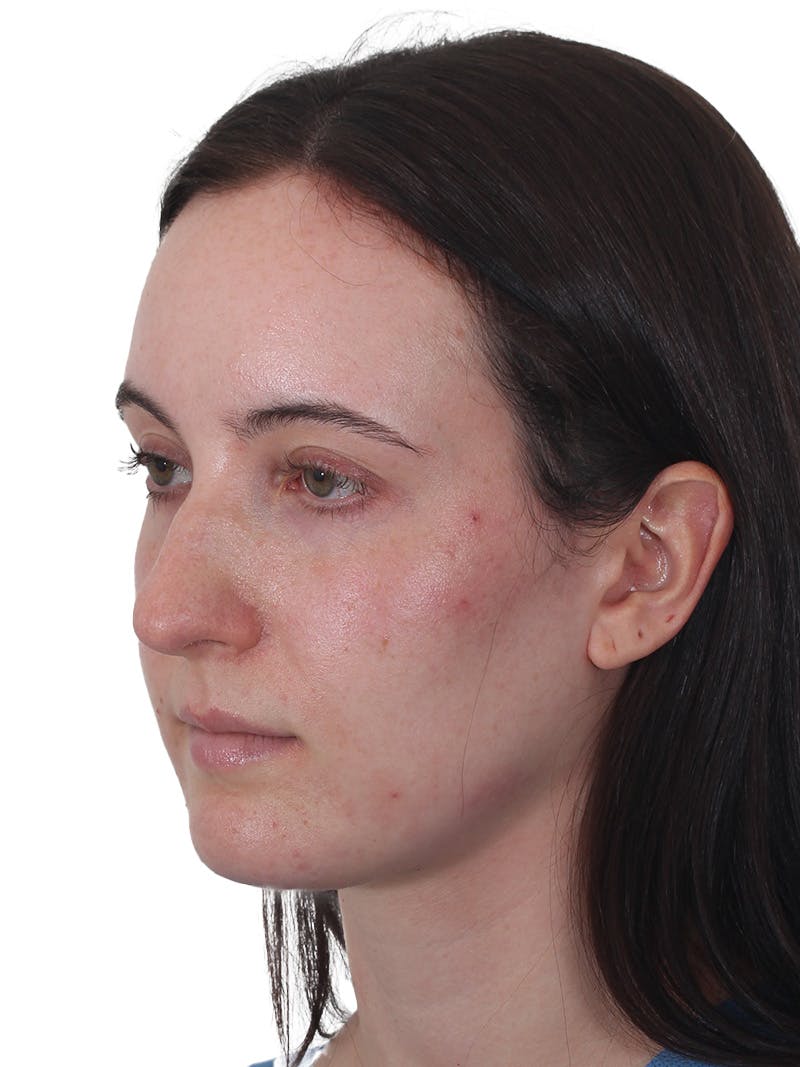 Rhinoplasty Before & After Gallery - Patient 260600 - Image 7