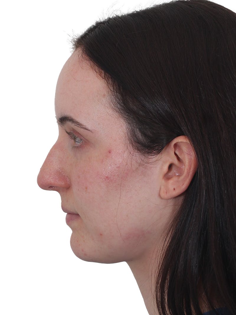 Rhinoplasty Before & After Gallery - Patient 260600 - Image 9
