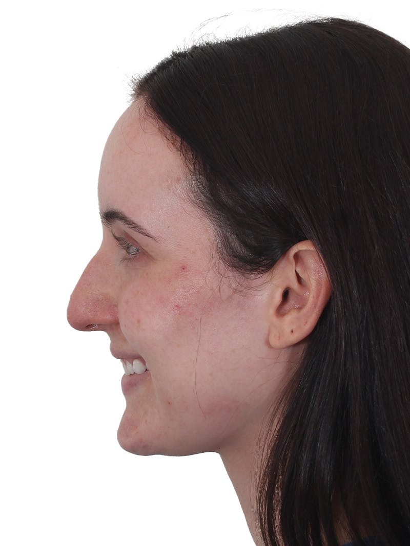 Rhinoplasty Before & After Gallery - Patient 260600 - Image 11