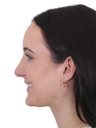 Rhinoplasty Before & After Gallery - Patient 260600 - Image 12