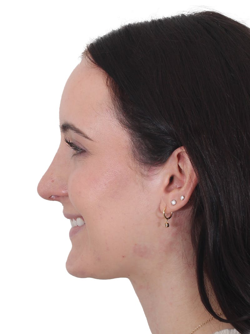 Rhinoplasty Before & After Gallery - Patient 260600 - Image 12