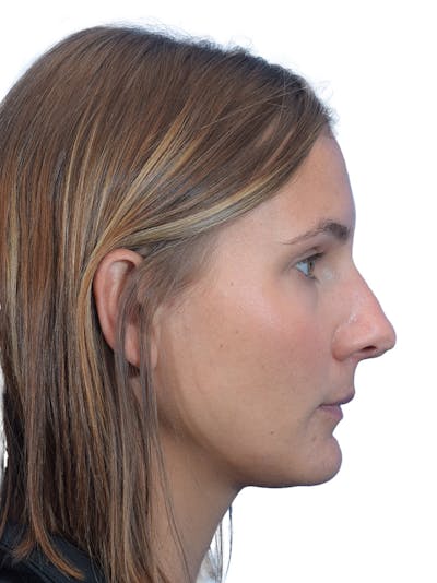 Rhinoplasty Before & After Gallery - Patient 140618 - Image 1