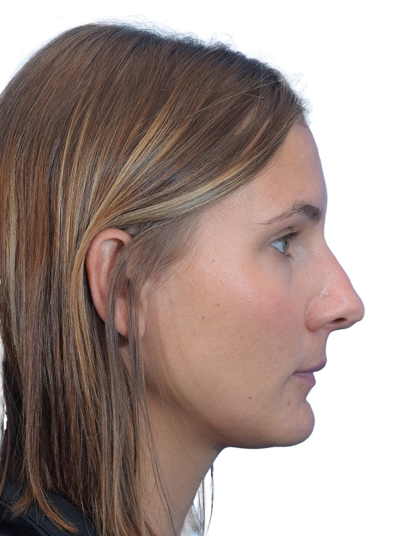 Rhinoplasty Before & After Gallery - Patient 140618 - Image 1
