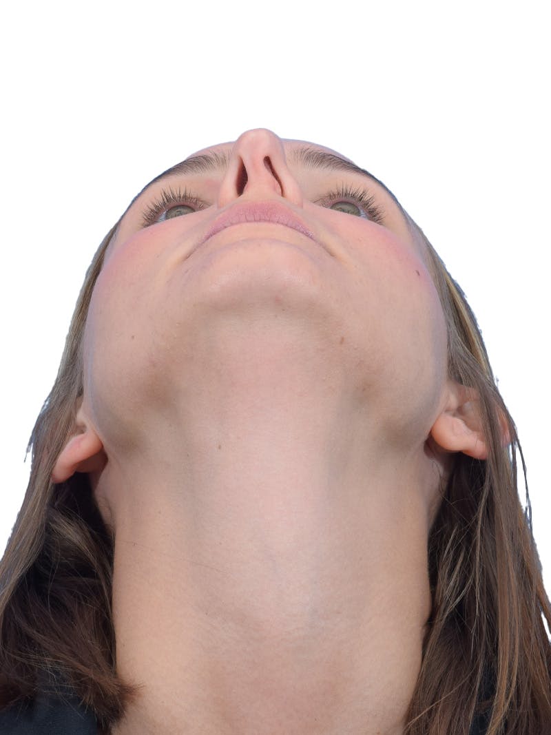 Rhinoplasty Before & After Gallery - Patient 140618 - Image 5