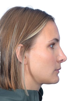 Rhinoplasty Before & After Gallery - Patient 140618 - Image 2