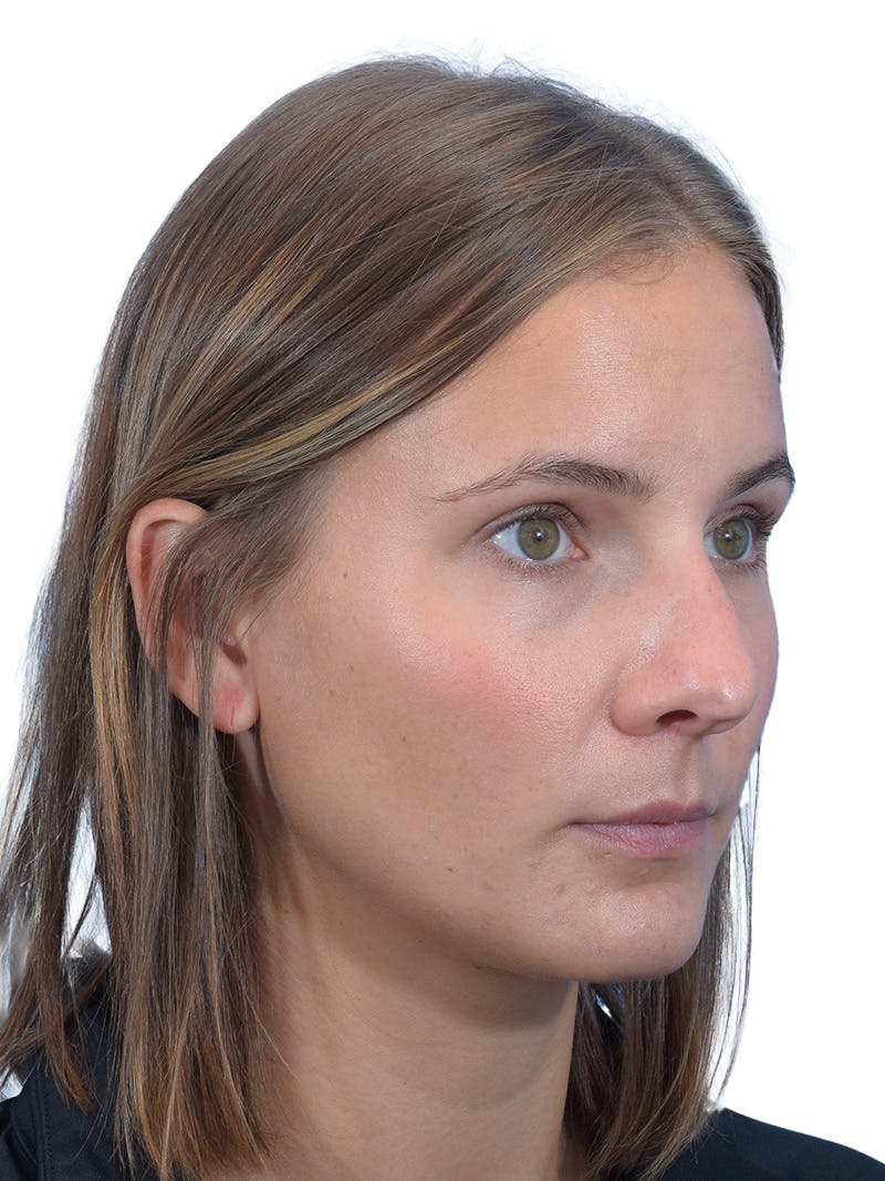 Rhinoplasty Before & After Gallery - Patient 140618 - Image 3