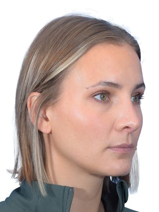 Rhinoplasty Before & After Gallery - Patient 140618 - Image 4