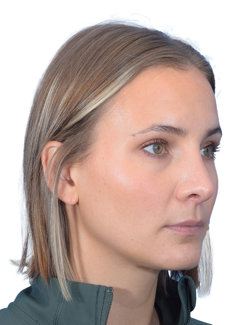 Rhinoplasty Before & After Gallery - Patient 140618 - Image 4