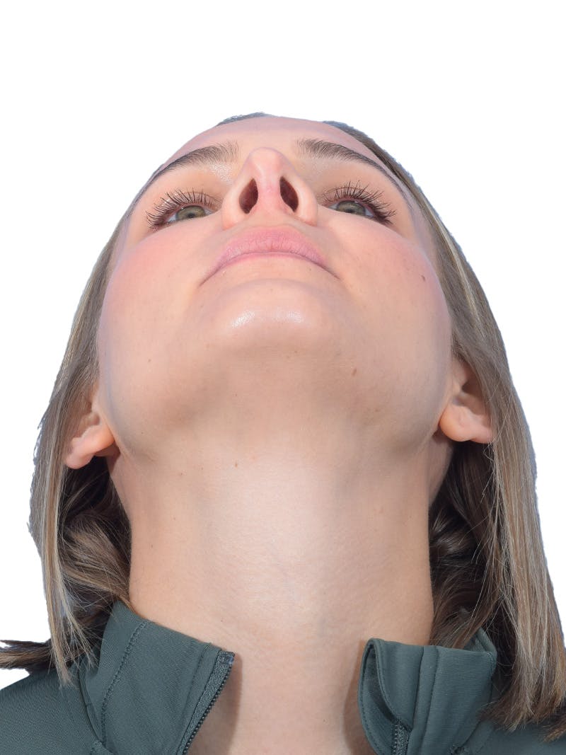 Rhinoplasty Before & After Gallery - Patient 140618 - Image 6