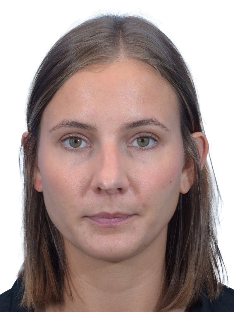 Rhinoplasty Before & After Gallery - Patient 140618 - Image 7