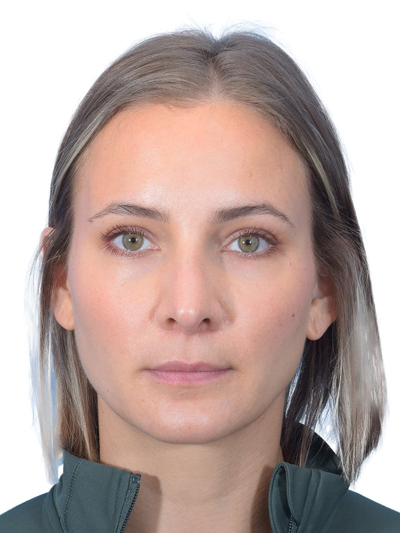 Rhinoplasty Before & After Gallery - Patient 140618 - Image 8