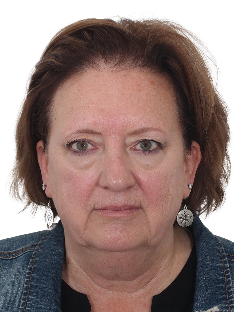 Laser Treatment Before & After Gallery - Patient 411345 - Image 1