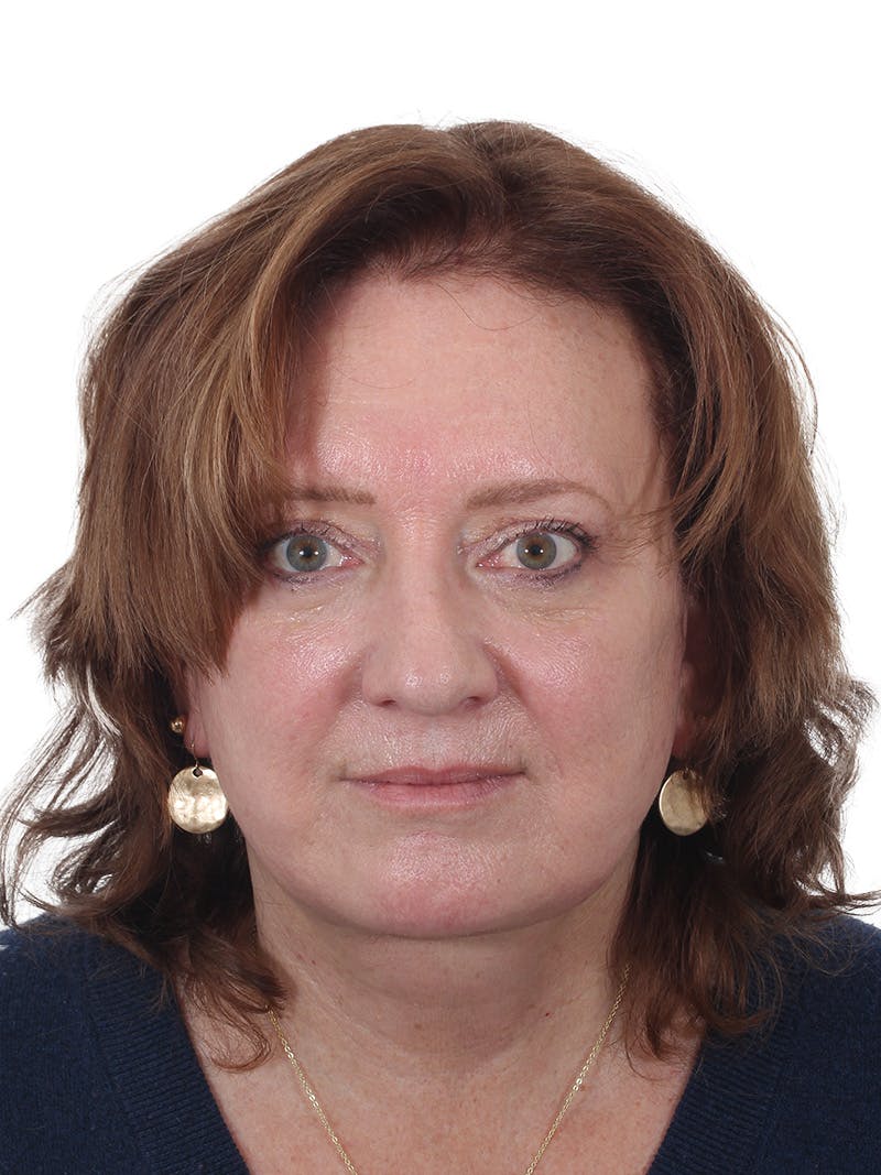 Laser Treatment Before & After Gallery - Patient 411345 - Image 2