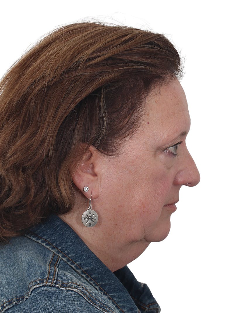 Laser Treatment Before & After Gallery - Patient 411345 - Image 5