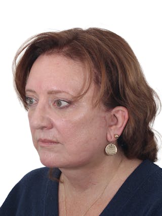 Laser Treatment Before & After Gallery - Patient 411345 - Image 10