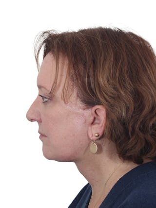 Laser Treatment Before & After Gallery - Patient 411345 - Image 12