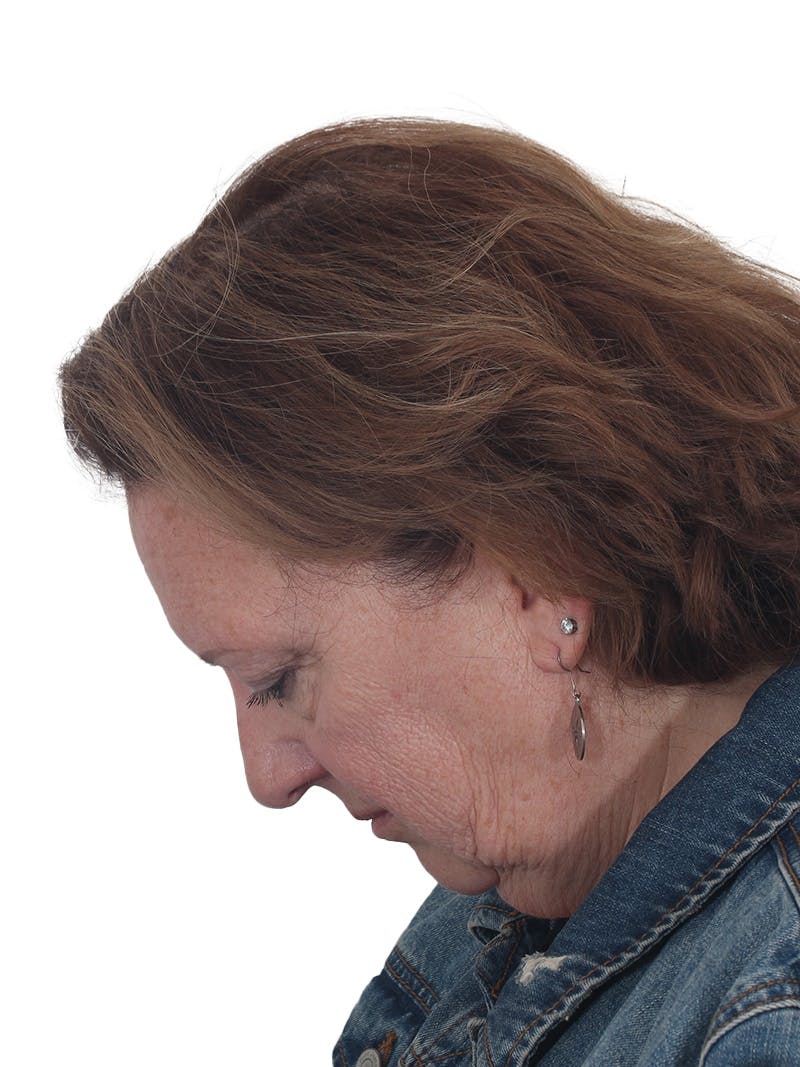 Laser Treatment Before & After Gallery - Patient 411345 - Image 13