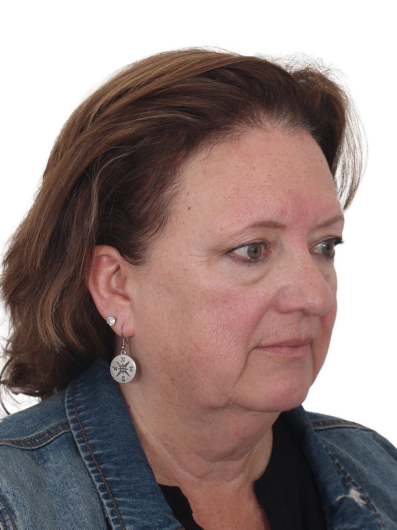 Laser Treatment Before & After Gallery - Patient 411345 - Image 3