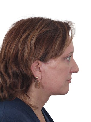 Laser Treatment Before & After Gallery - Patient 411345 - Image 6