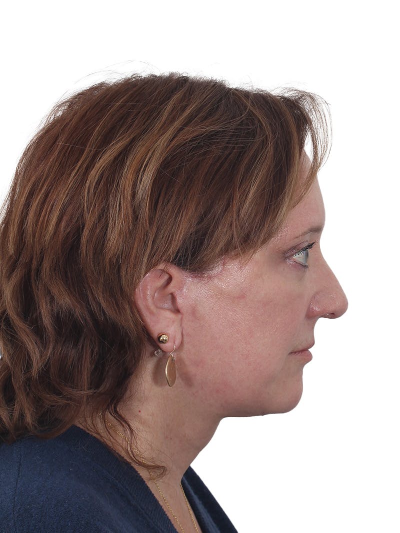 Laser Treatment Before & After Gallery - Patient 411345 - Image 6