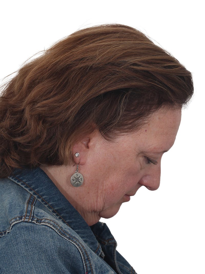 Laser Treatment Before & After Gallery - Patient 411345 - Image 7