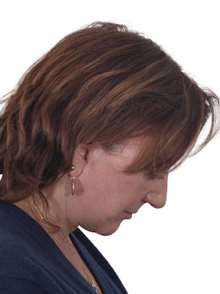 Laser Treatment Before & After Gallery - Patient 411345 - Image 8