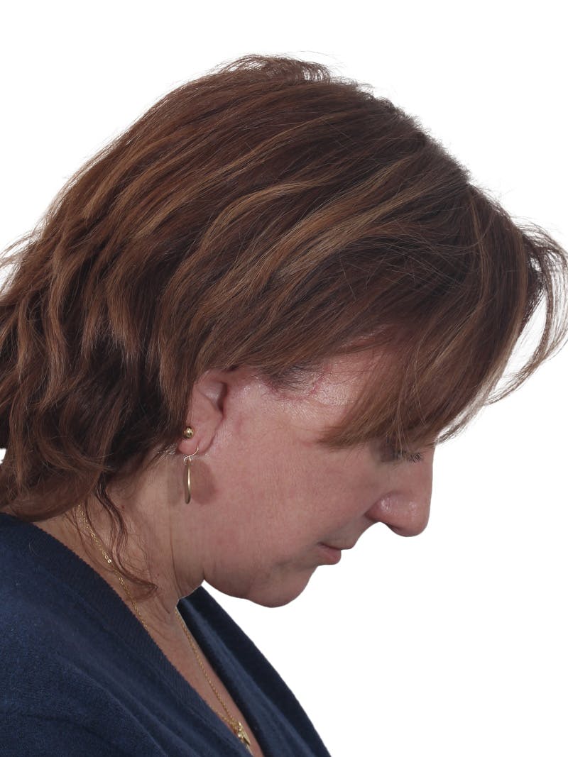 Laser Treatment Before & After Gallery - Patient 411345 - Image 8
