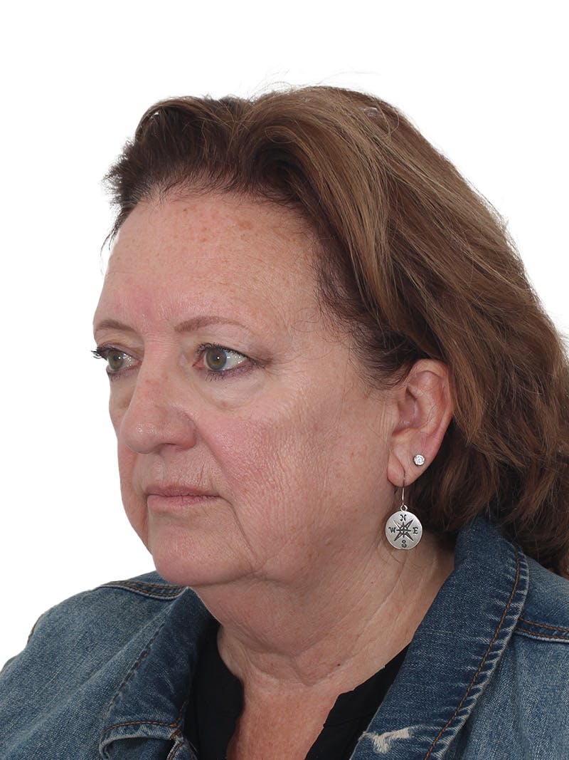 Laser Treatment Before & After Gallery - Patient 411345 - Image 9