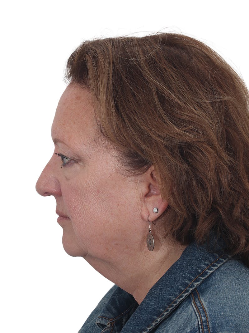 Laser Treatment Before & After Gallery - Patient 411345 - Image 11