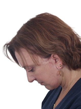 Laser Treatment Before & After Gallery - Patient 411345 - Image 14