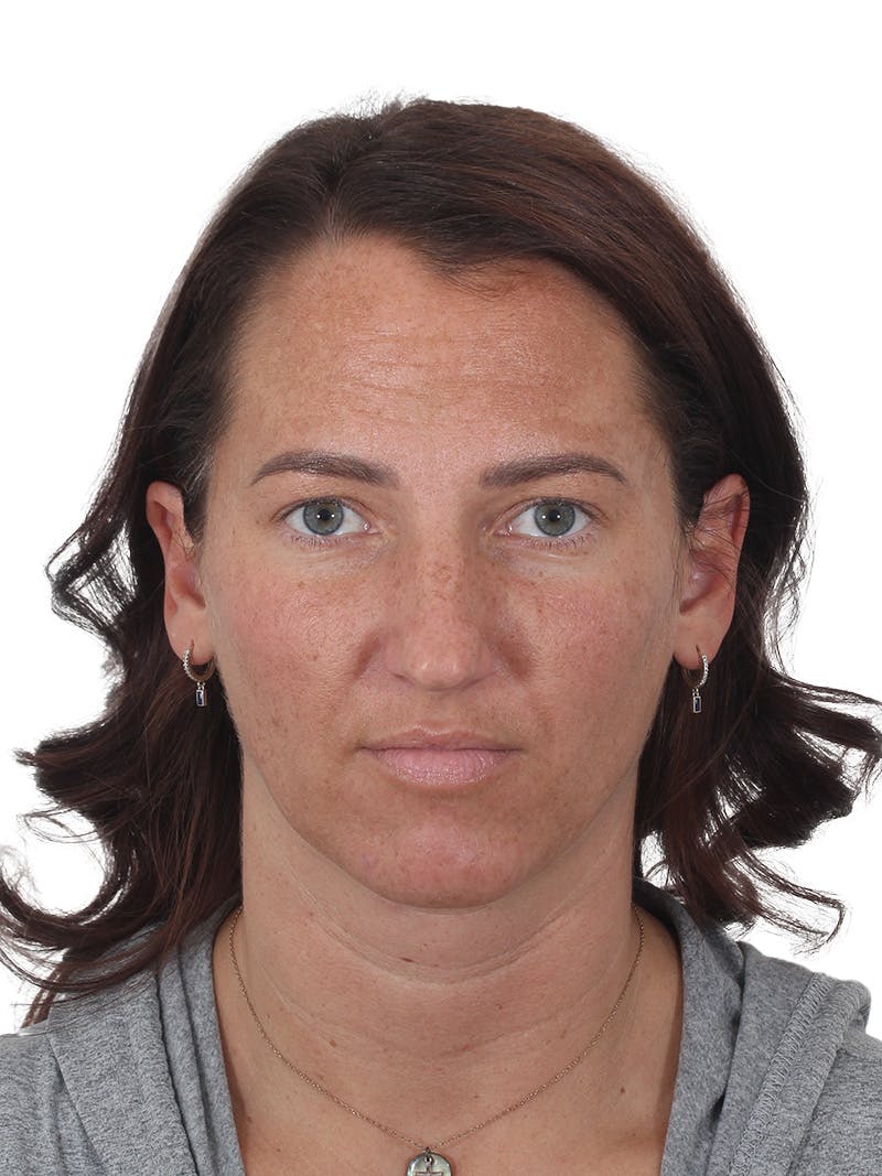 Rhinoplasty Before & After Gallery - Patient 161888 - Image 5