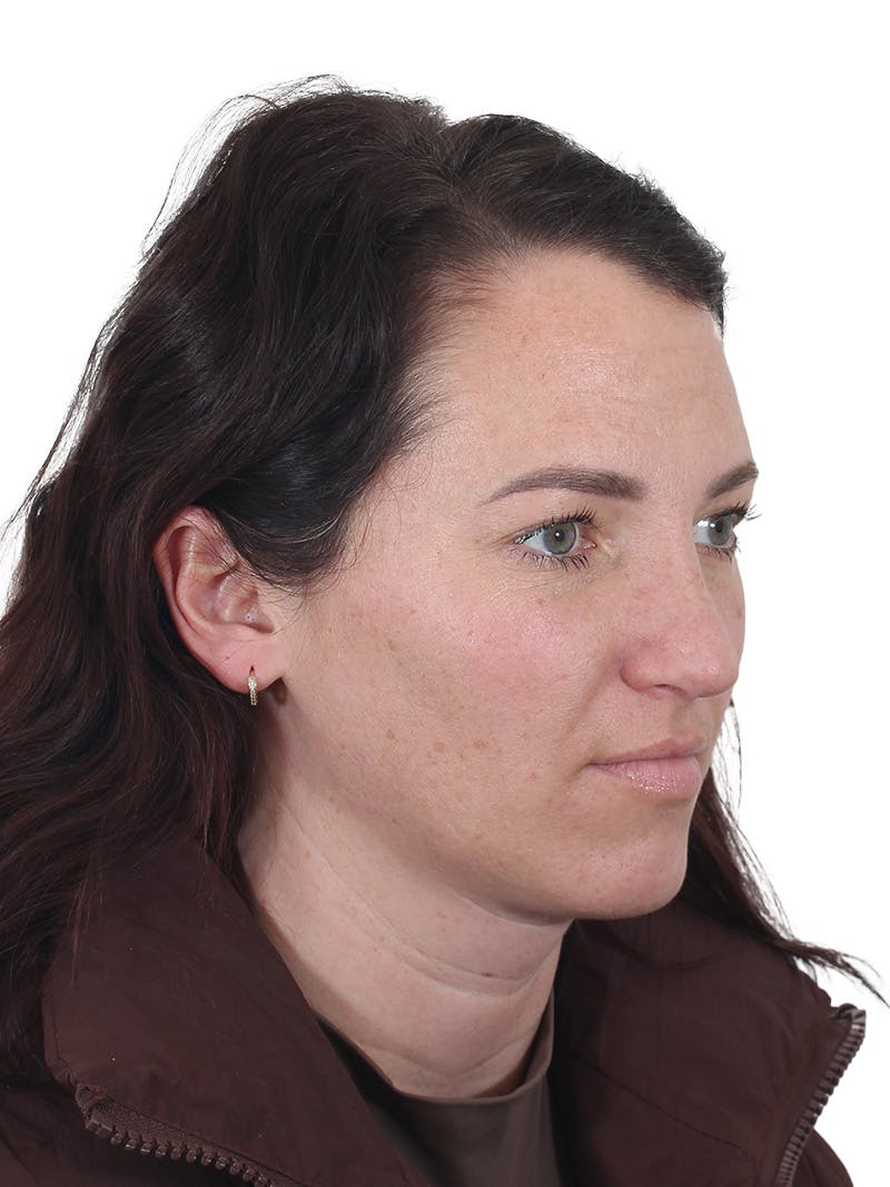 Rhinoplasty Before & After Gallery - Patient 161888 - Image 4