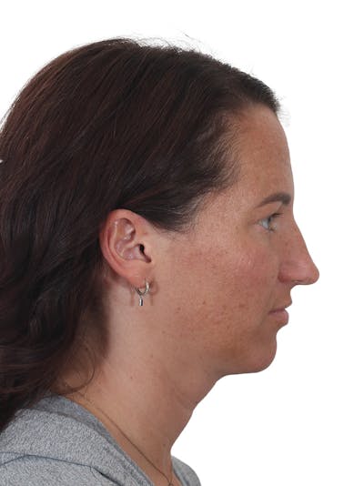 Rhinoplasty Before & After Gallery - Patient 161888 - Image 1