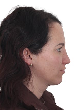 Rhinoplasty Before & After Gallery - Patient 161888 - Image 2