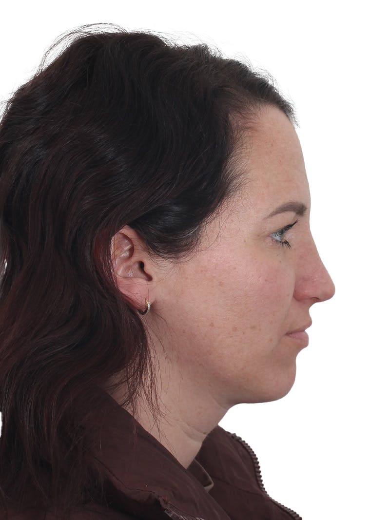 Rhinoplasty Before & After Gallery - Patient 161888 - Image 2