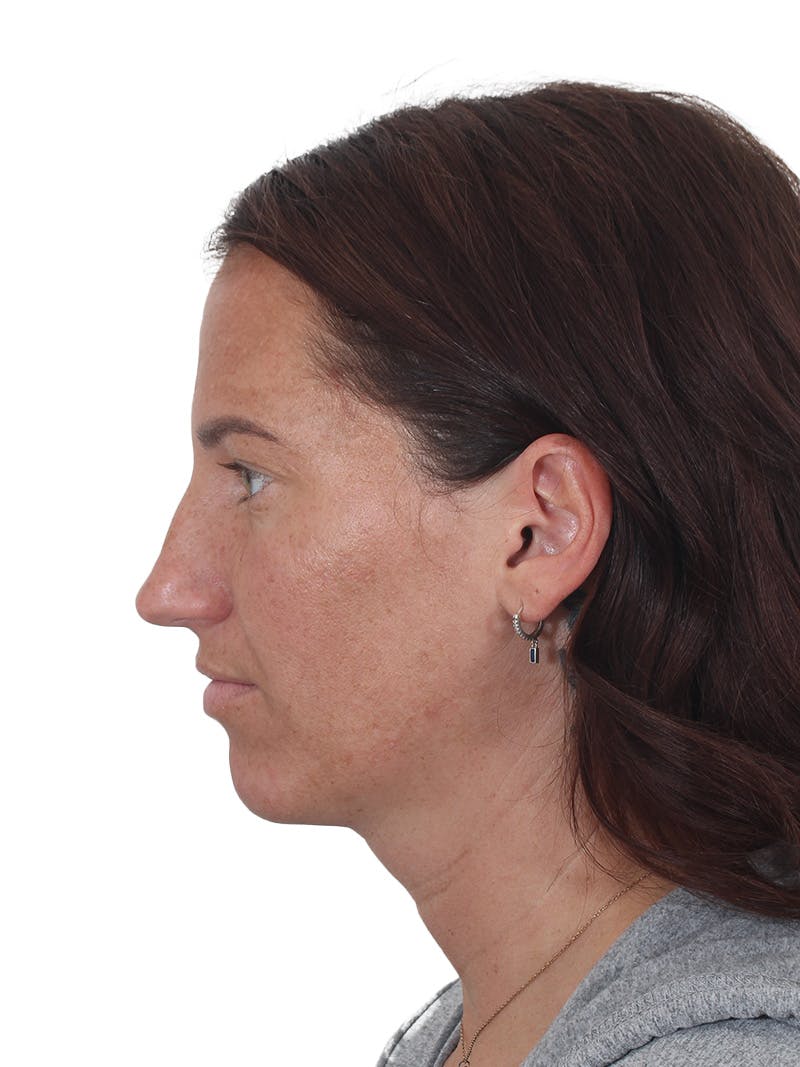 Rhinoplasty Before & After Gallery - Patient 161888 - Image 9