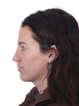 Rhinoplasty Before & After Gallery - Patient 161888 - Image 10