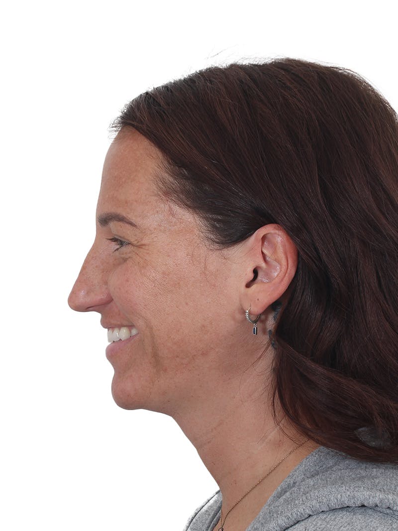 Rhinoplasty Before & After Gallery - Patient 161888 - Image 11