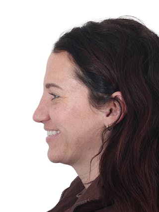 Rhinoplasty Before & After Gallery - Patient 161888 - Image 12