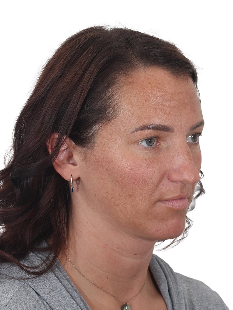 Rhinoplasty Before & After Gallery - Patient 161888 - Image 3