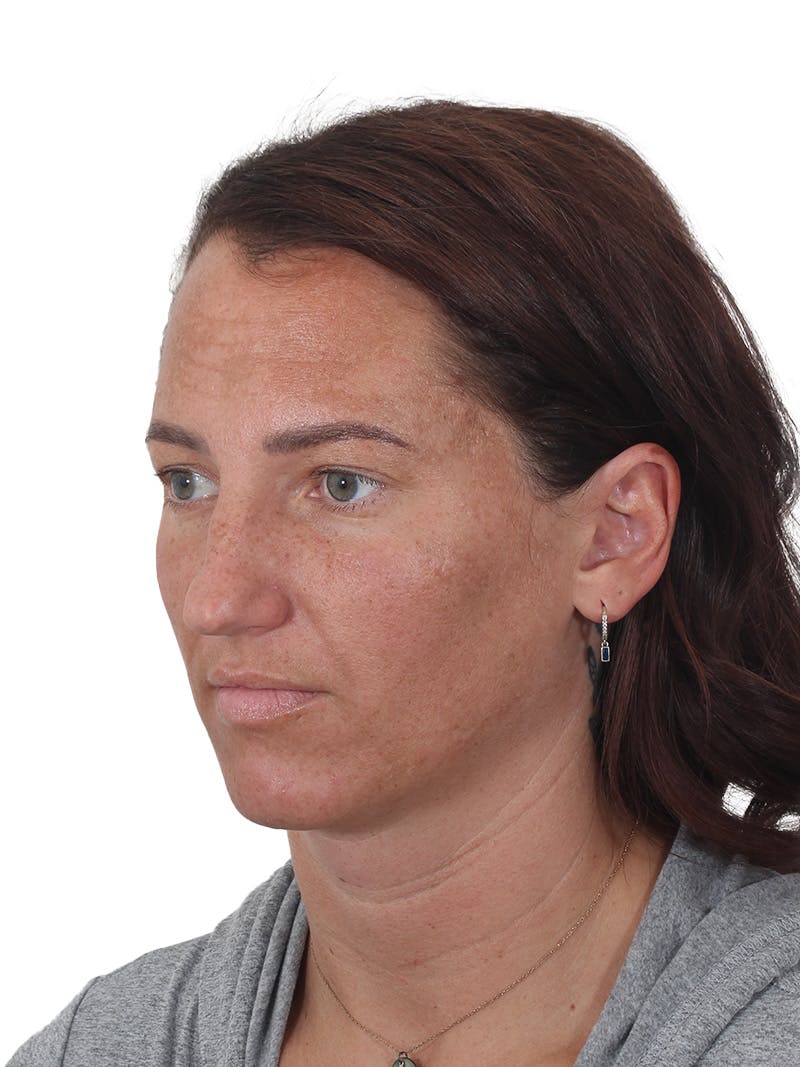 Rhinoplasty Before & After Gallery - Patient 161888 - Image 7
