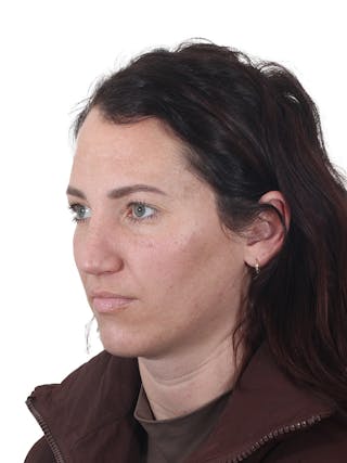 Rhinoplasty Before & After Gallery - Patient 161888 - Image 8