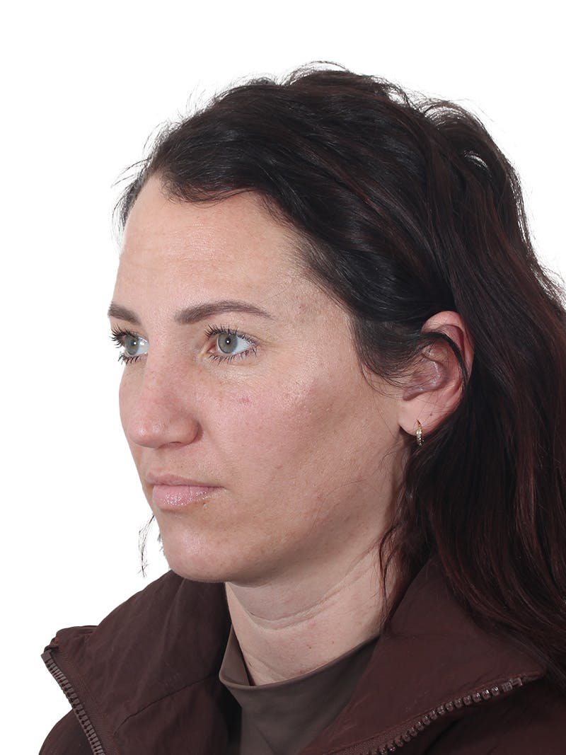 Rhinoplasty Before & After Gallery - Patient 161888 - Image 8